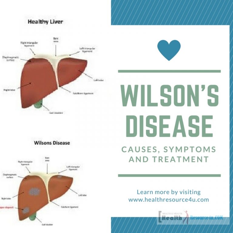 Wilsons Disease Causes Symptoms and Treatment