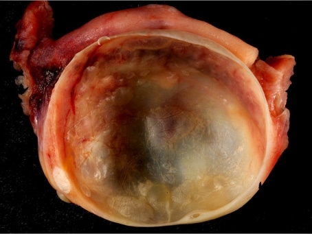 Ovary Cyst