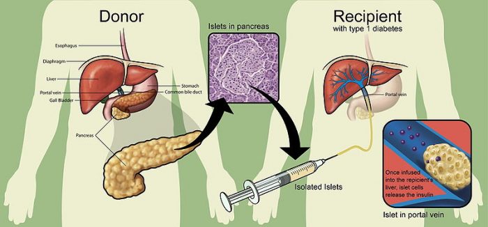 Liver Transplant Treatment of Wilson’s Disease: