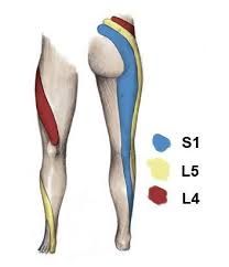 Sciatica Caused by a Herniated Disc