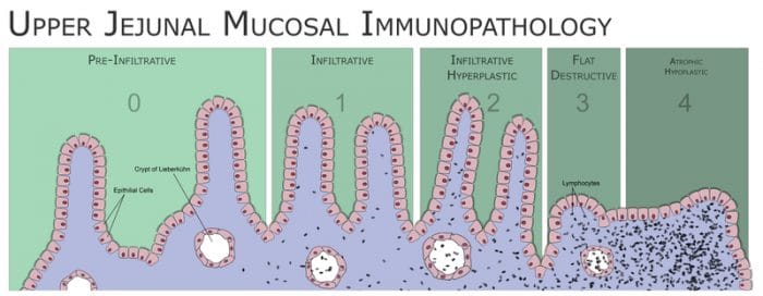 celiac disease