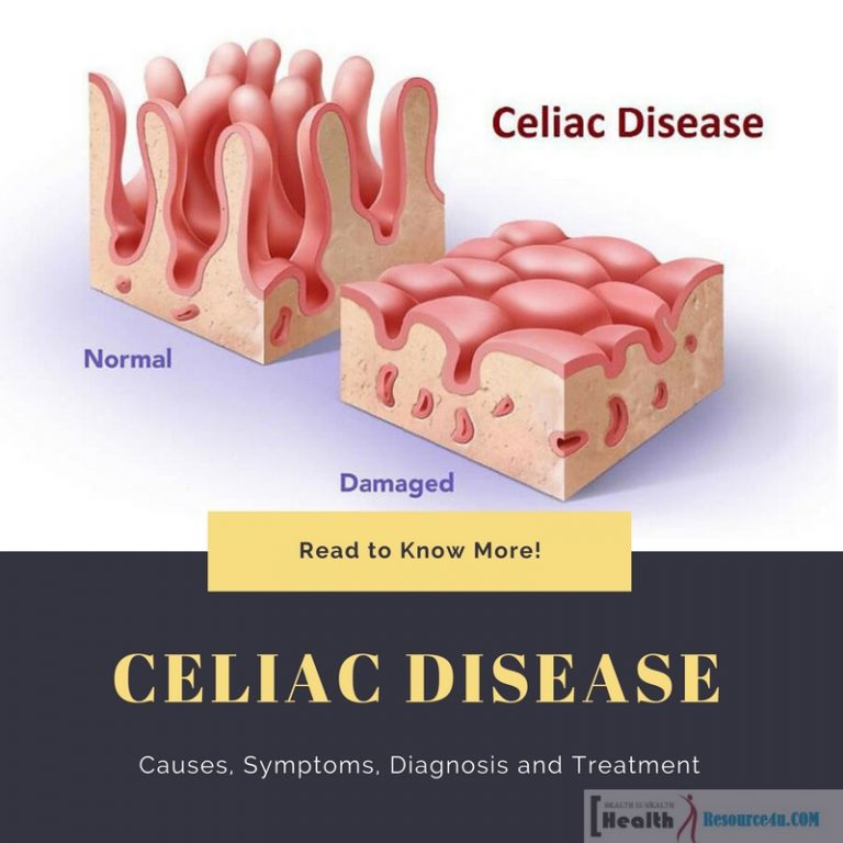 Celiac Disease causes treatment