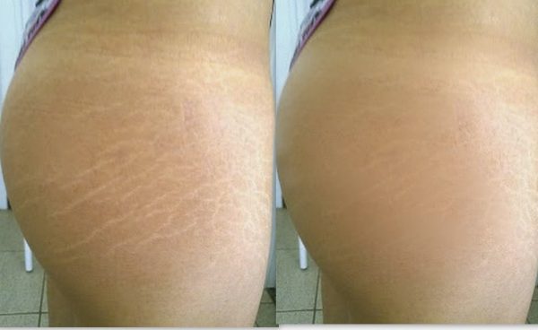 Laser Therapy for Removing Stretch Marks