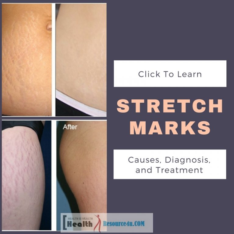 Stretch Marks causes