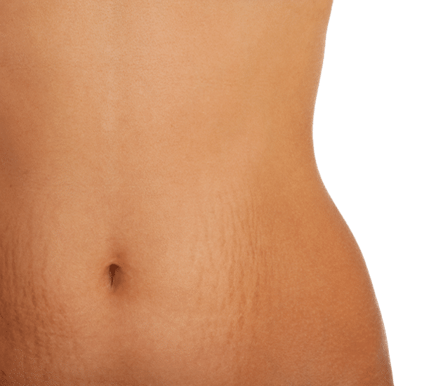 Causes of Stretch Marks