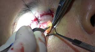  Surgical procedure