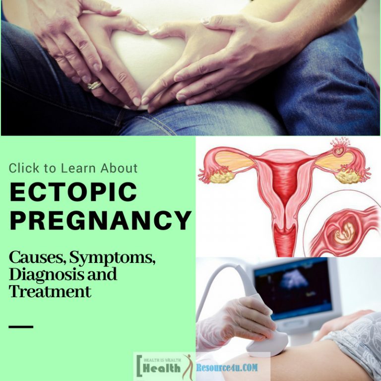 Ectopic Pregnancy 1