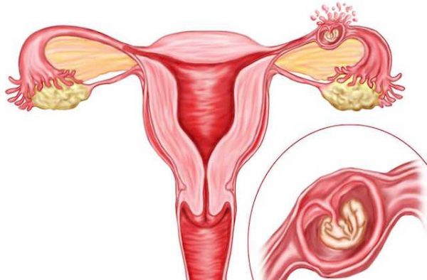 Ectopic Pregnancy