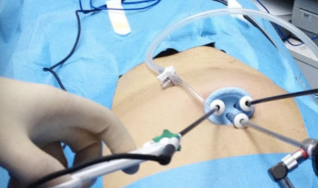 Laparoscopic surgery