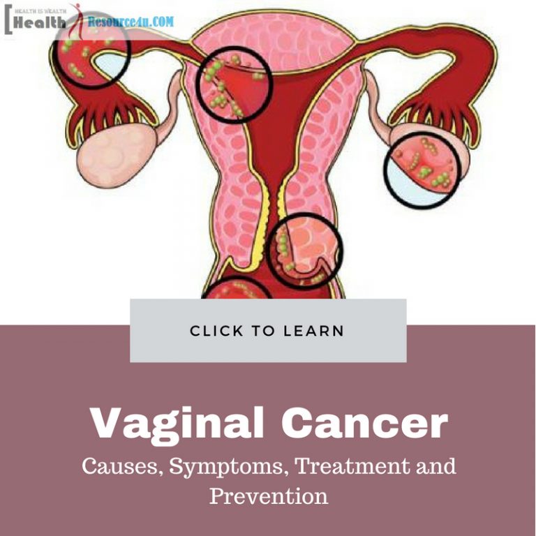 Vaginal Cancer