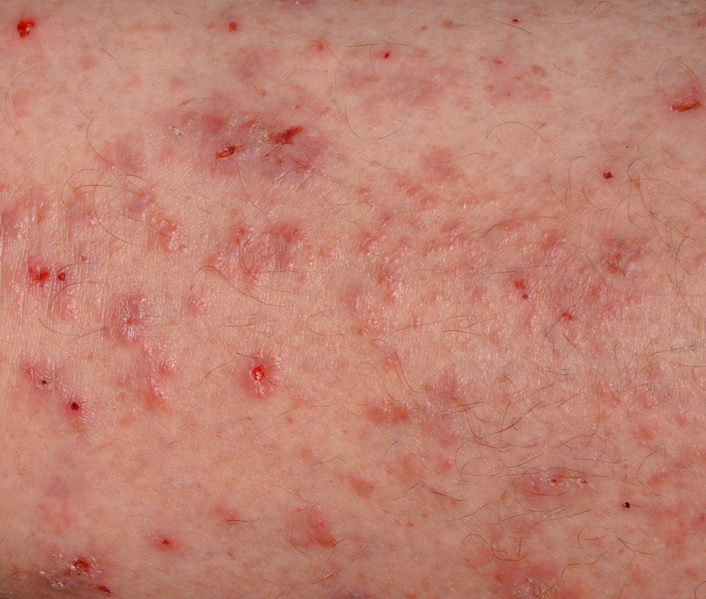 scabies