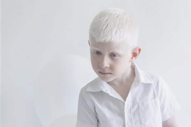 Albinism