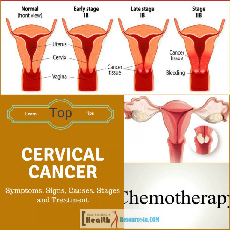 Cervical Cancer Causes Treatment