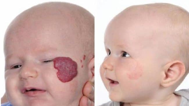 Hemangioma