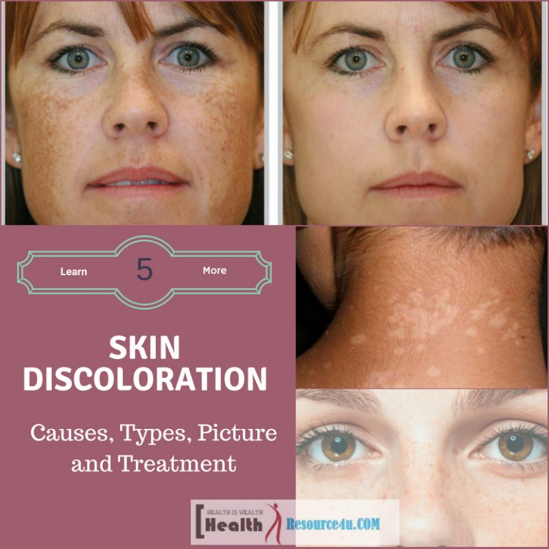 How to Treat Hyperpigmentation and Discoloration -