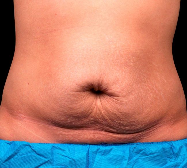 Stomach-loose-skin