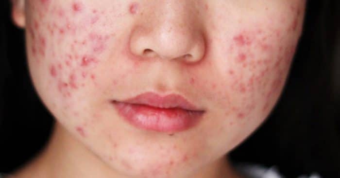 best acne home treatments for your skin