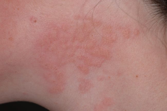 eczema