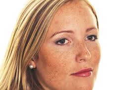 melasma