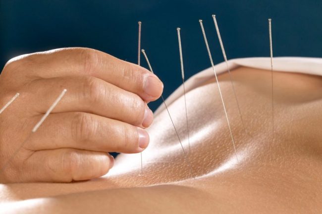 Acupuncture