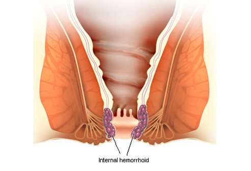 Home Remedies for Hemorrhoids