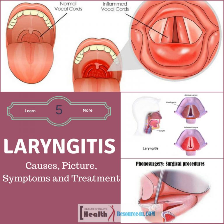 Laryngitis causes treatment