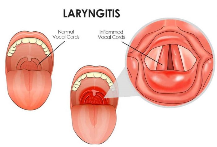 Laryngitis