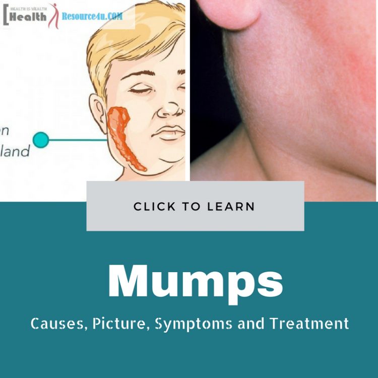 Mumps causes treatment