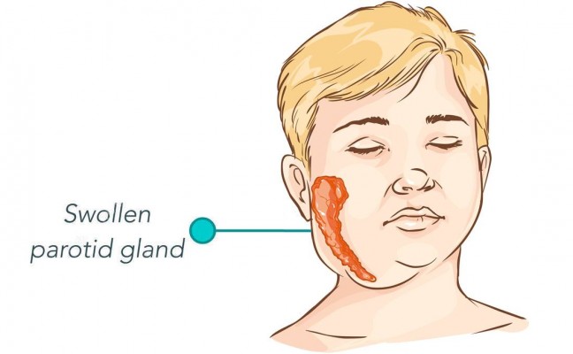 Mumps treatment