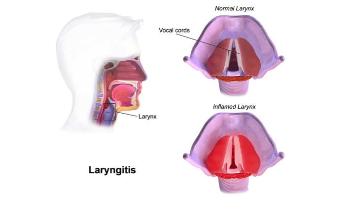 Risk Factors for Laryngitis