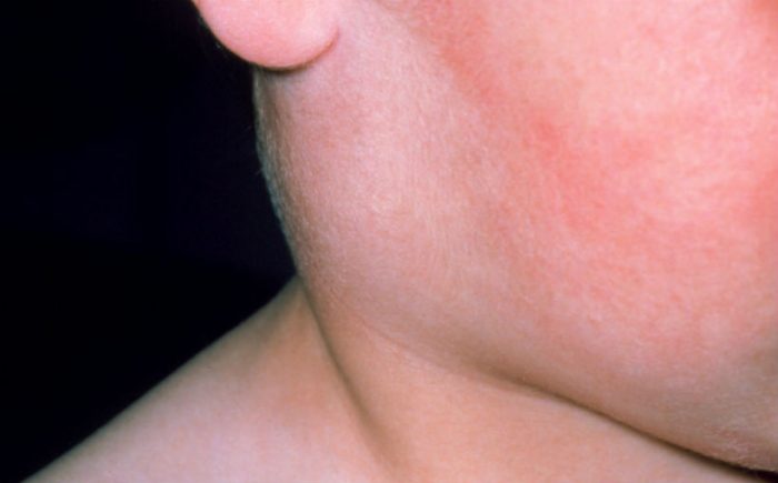 baby-with-mumps