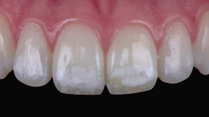 Dental Fluorosis Treatment