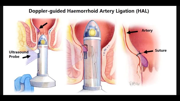 surgical options hemorrhoids