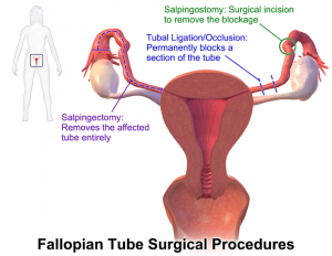 tubal ligation periods fallopian ptls