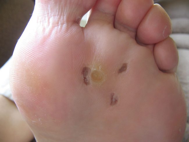 plantar warts