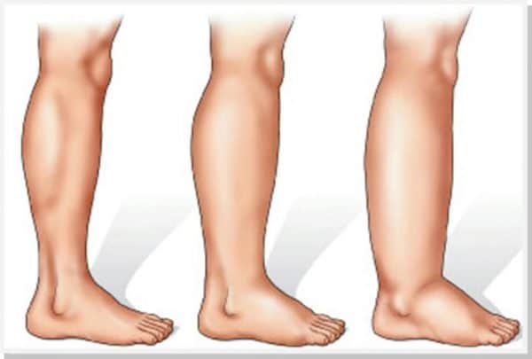 Lymphedema