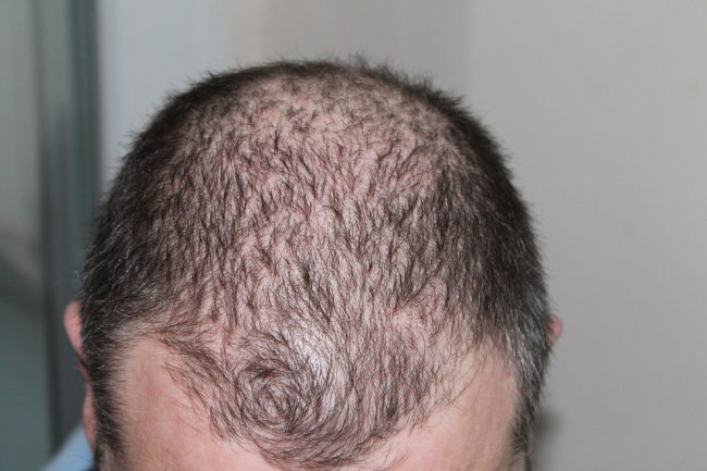 Hair Transplant Restoration Surgery