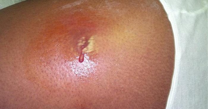 staph infection treatment