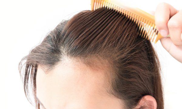 natural tips to treat hair loss