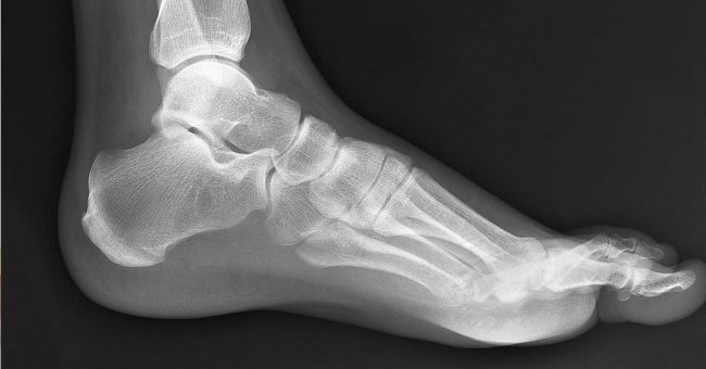 treatment of metatarsal stress fracture