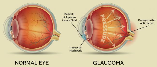 facts about glaucoma