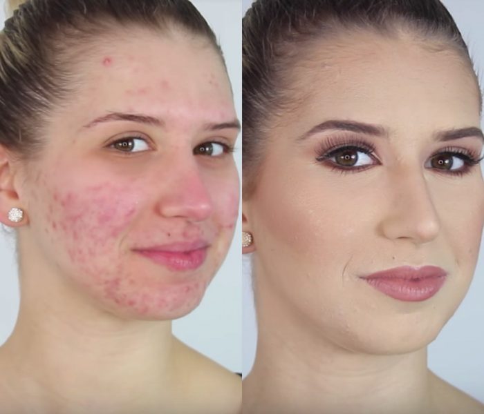 effective treatment methods to cure acne in 3 days