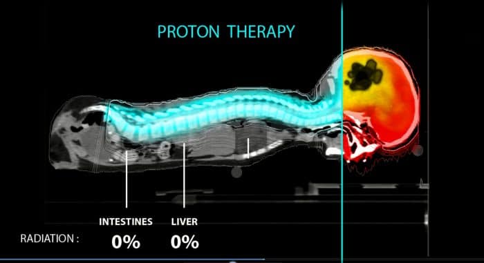 Proton therapy for cancer treatment