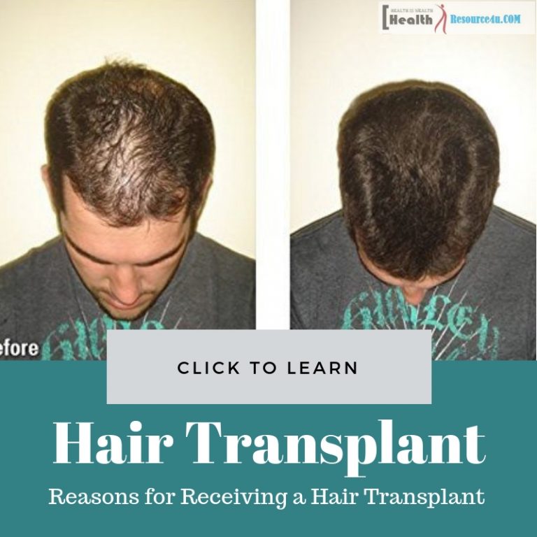 Reasons for Receiving a Hair Transplant