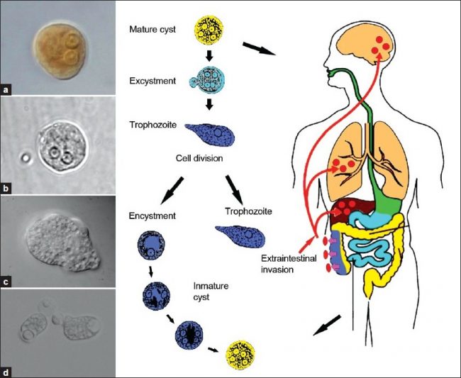 symptoms of Amebiasis