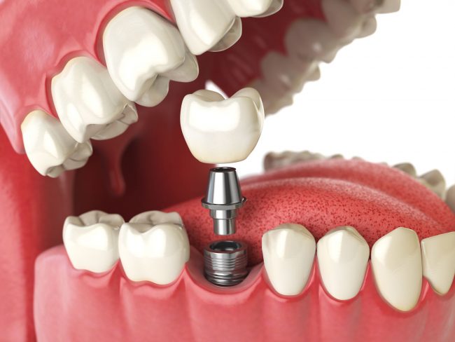 dental implants surgery