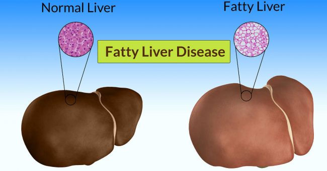 atty-liver