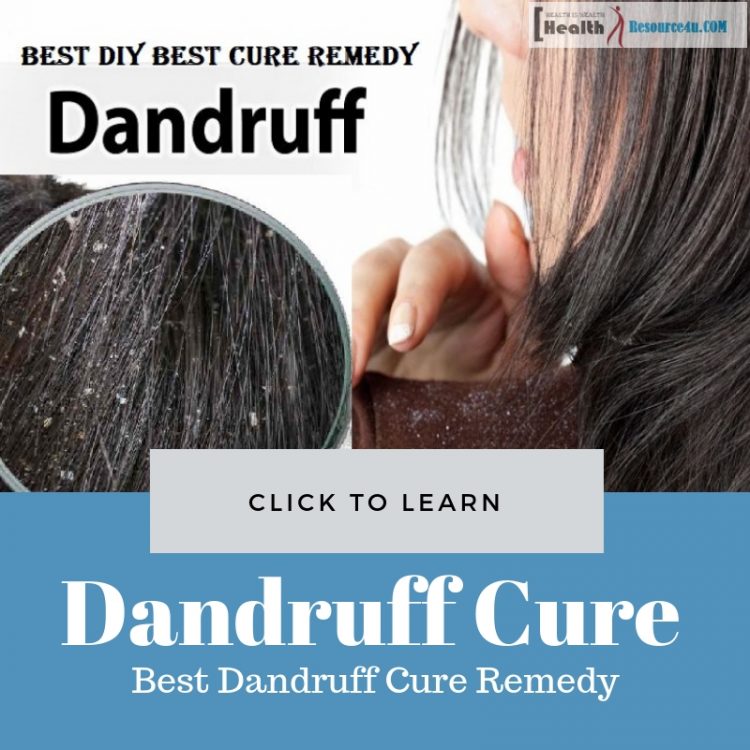 Best Dandruff Cure Remedy