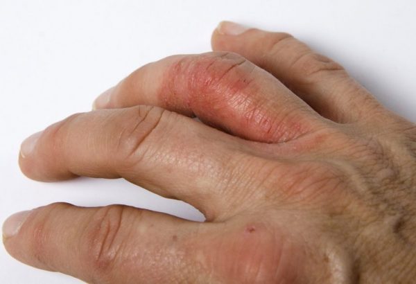 symptoms of dactylitis