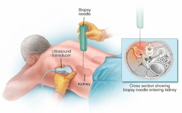 What to Expect from the Biopsy